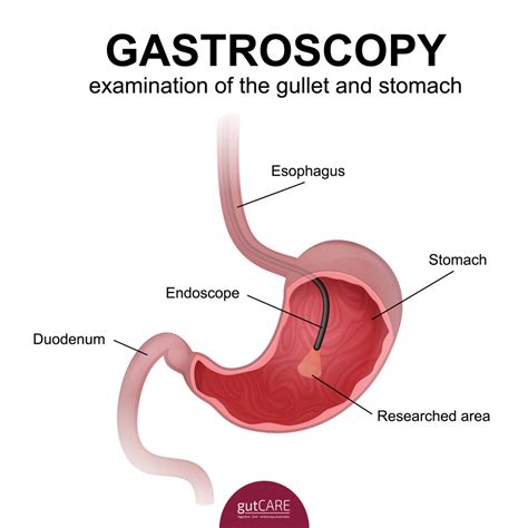 Gastroscopy Upper Gi Endoscopy Singapore Cost Gutcare