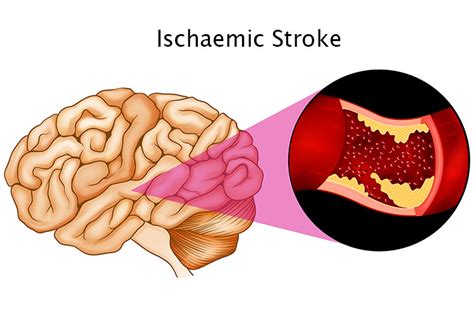 Neural Mechanisms Of Spontaneous Recovery In Stroke Ausmed