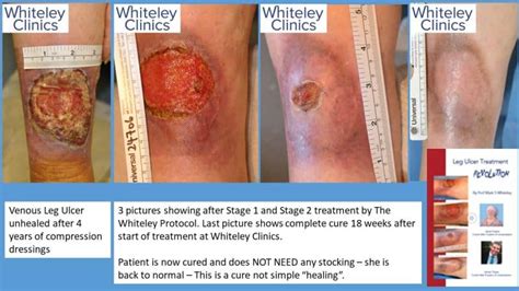 Leg Ulcer Treatment Revolution Cure For Venous Leg Ulcers The