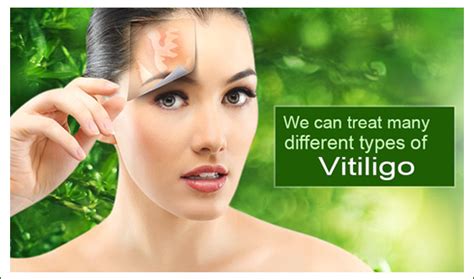 What Is Vitiligo Vitiligoleucoderma Treatment Hospitalclinic