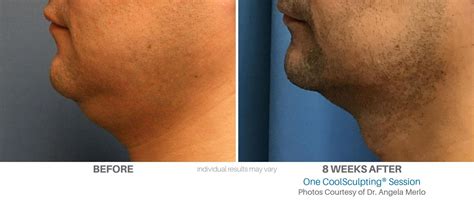 Coolsculpting Before And After Images Real Patient Results
