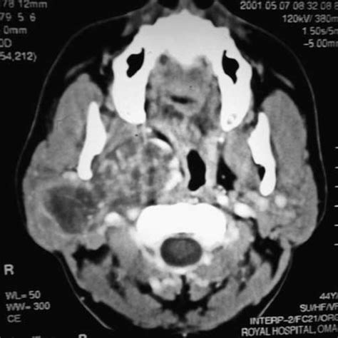 Ct Scan Showing The Tumor From The Deep Part Of Parotid Gland