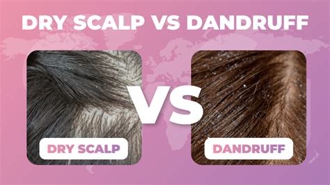 Dry Scalp Vs Dandruff Difference Causes And Treatment