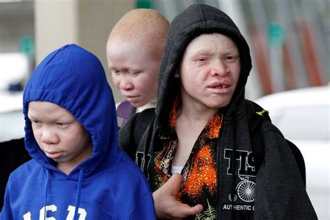 Tanzanian Albino Children Attacked For Body Parts Seek Care In Us