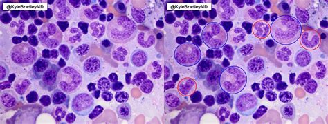 Megaloblastic Neutrophils In Bone Marrow So Called Grepmed