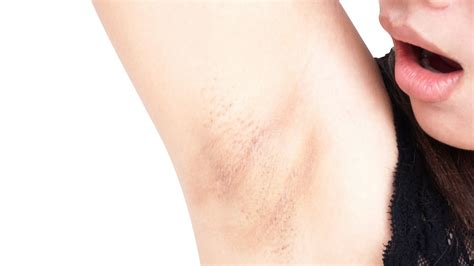 6 Common Causes Of Armpits Rashes Duradry