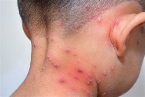 Measles Viral Rashes In Babies Adult Rash Okegoal