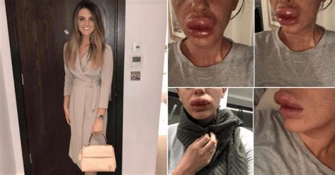 Woman Nearly Lost Her Lip After Fillers Injected At A Botox Party Caused Mouth To Swell Twice