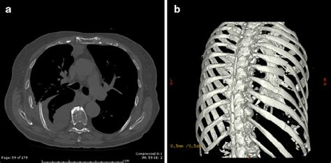 A Axial computed tomography cut showing a large right-sided effusion ...