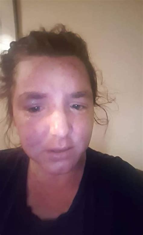 Woman Claims To Have Cleared Up Her Severe Eczema With Cbd Oil Tyla
