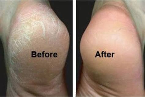 Home Remedies For Cracked Heels That You Need To Try Out Alldaychic