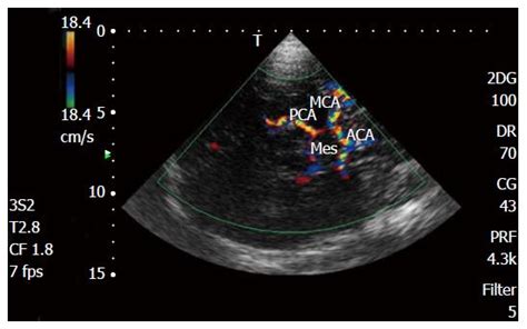 Transcranial Doppler Ultrasonography From Methodology To Major