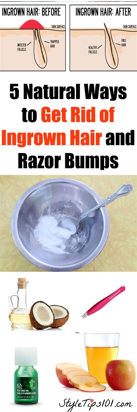 5 Ways To Get Rid Of Ingrown Hair Or Razor Bumps