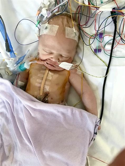 Powerful Pictures Show Strong Baby Recovering From Open Heart Surgery
