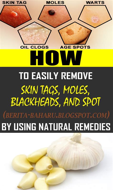 How To Easily Remove Skin Tags Moles Blackheads Spots And Warts By