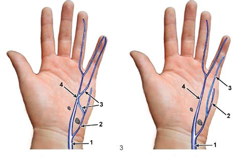 Figure 1 From Topography Of Ulnar Nerve And Its Variations With Special