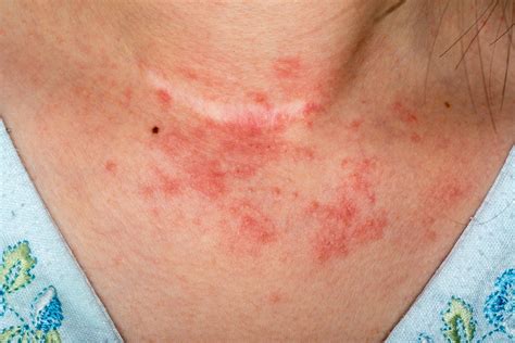 Do You Have An Itchy Red Rash Possibly With Bumps And Blisters You