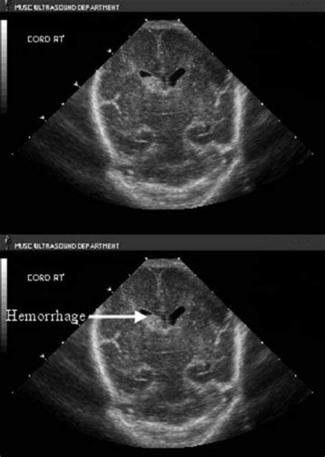Intraventricular Hemorrhage Ultrasound Obstetric Ultrasound