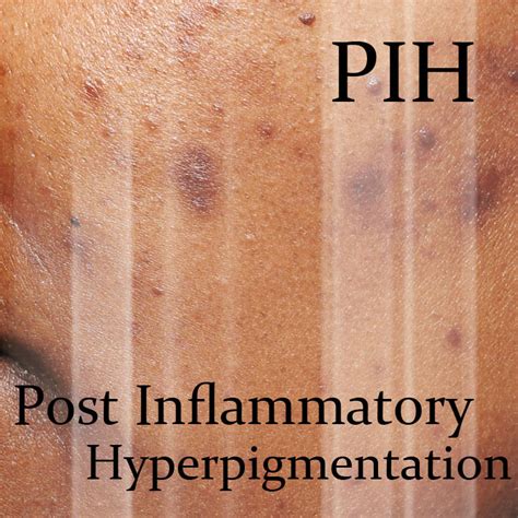 Post Inflammatory Hyperpigmentation Treatment Dr Sin Yong