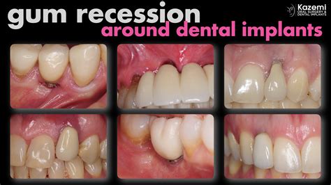 Gum Recession Around Dental Implants Gum Recession Around Dental