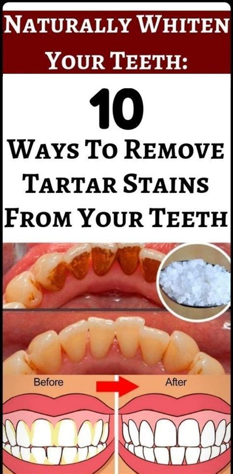 Naturally Whiten Teeth 10 Ways To Remove Tartar Stains From Your Teeth