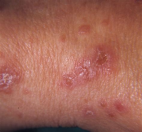Dermatitis Herpetiformis Duhrings Disease