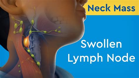 Swollen Lymph Node In Neck One Side Ostomy Lifestyle All In One Photos