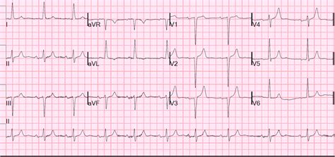 Dr Smith S ECG Blog Bradycardia