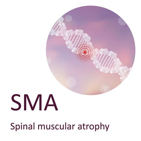 Spinal Muscular Atrophy Sma Rare Disease Advisor
