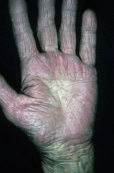 Eczema In Humans Pictures 47 Photos And Images