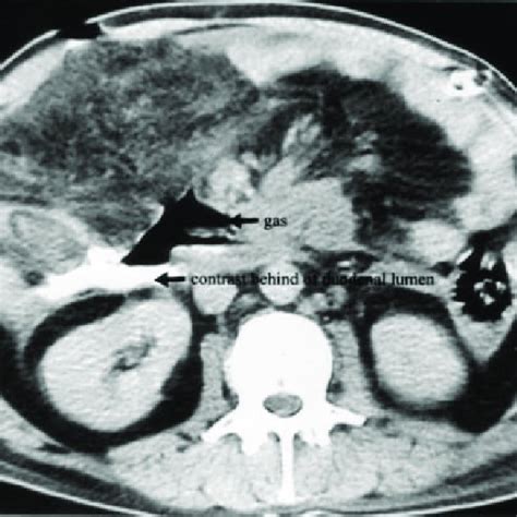 Ct Scan Contrast Dye Administered Orally Present Outside Of Duodenal