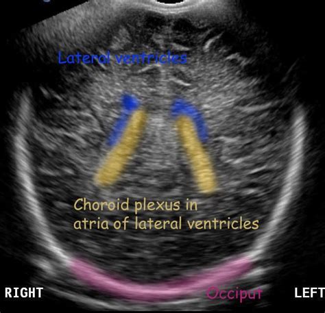 Normal Neonatal Head Ultrasound Diagnostic Medical Sonography