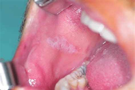 Diagnostika Bielych Plôch V Dutine ústnej Slovenský Spolok študentov Zubného Lekárstva