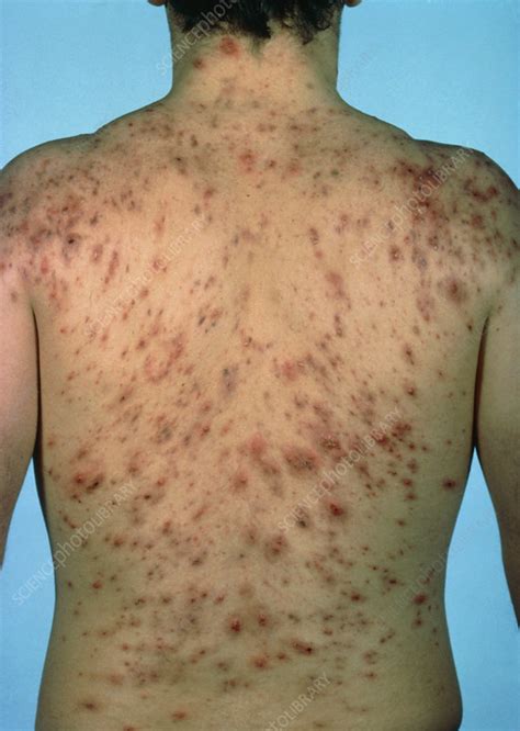 Acne Vulgaris Scarring Over A Mans Back Stock Image M1080124