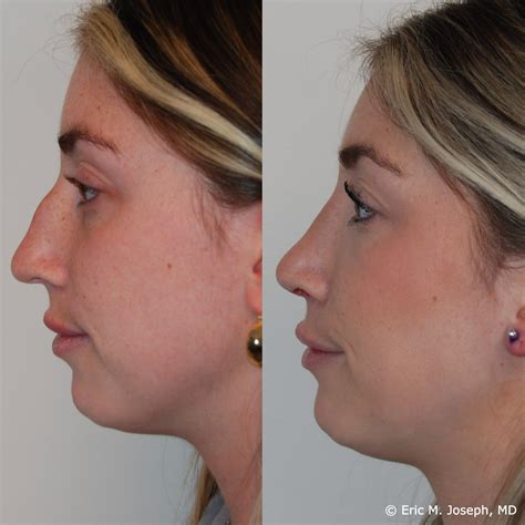 Eric M Joseph Md Rhinoplasty Before And After Photos