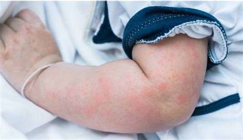 Urticaria In Children Symptoms Causes And Treatment