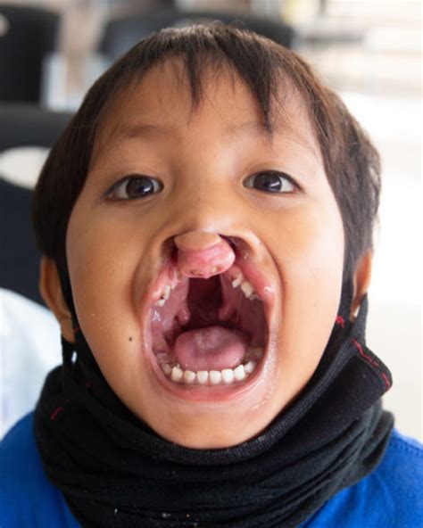 Conditions We Treat Cleft Lip And Cleft Palate Cure International Uk