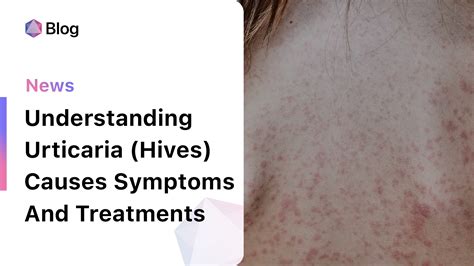 Understanding Urticaria Hives Causes Symptoms And Treatments