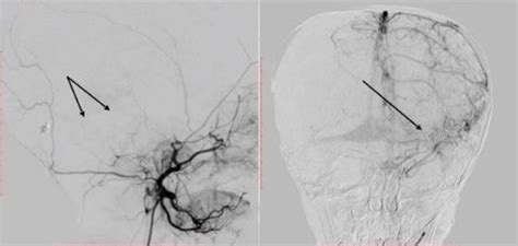 Lateral Left External Carotid Artery Angiogram A And Anteroposterior