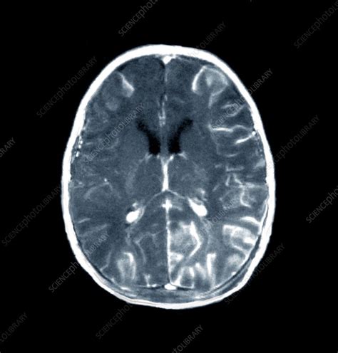 Brain In Meningitis Ct Scan Stock Image C0267940 Science Photo