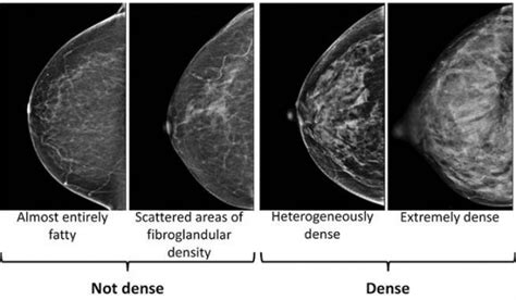 Whats The Best Way To Screen Dense Breasts Cancer Health