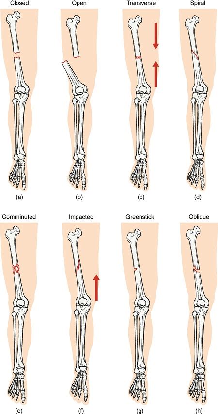 Bone Fracture Definition Types Repair Study Com