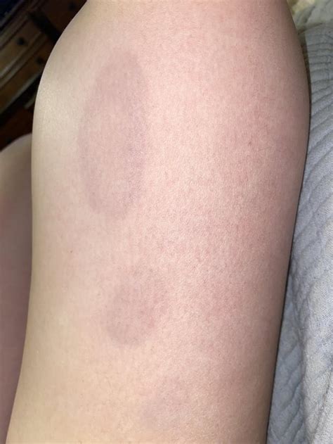 My Wife Just Noticed She Got These Odd Purple Bruise Like Spots On Her