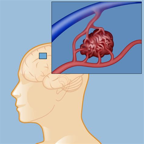 Arteriovenous Malformation Avm Weill Cornell Brain And Spine Center