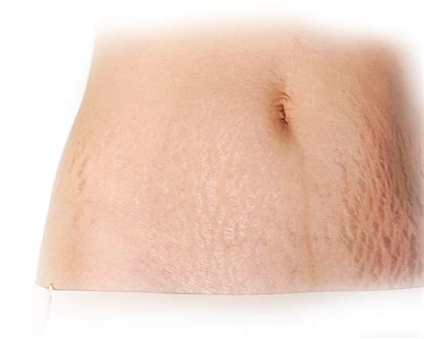 stretch mark removal clinic in hyderabad stretch marks treatment
