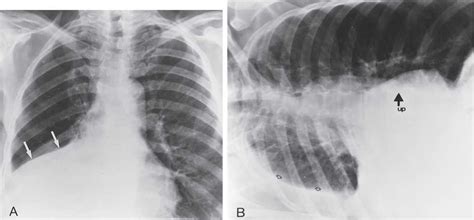 Pleural effusion (transudate or exudate) is an accumulation of fluid in the chest or on the lung. Loculated Pleural Fluid