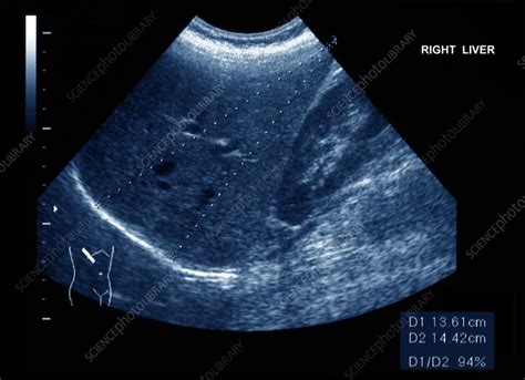 Normal Liver Ultrasound Scan Stock Image C0552784 Science Photo