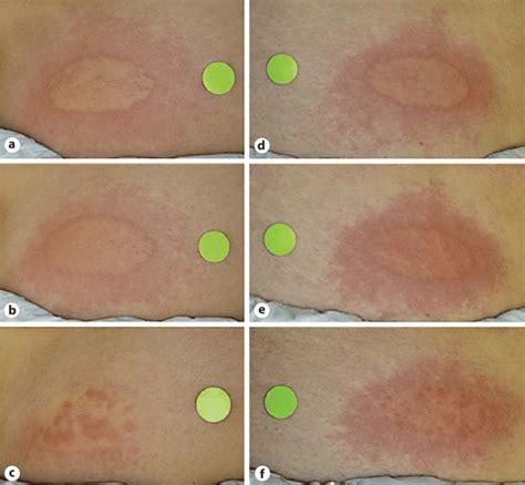 Representative Photographs Of Skin Reactions To Histamine Iontophoresis