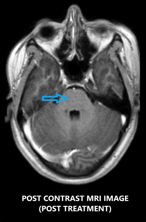 Clippers Mri Chronic Lymphocytic Inflammation With Pontine