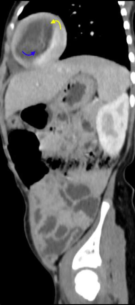 A B Selected Sagittal Contrast Enhanced Abdomen Ct Scan Images